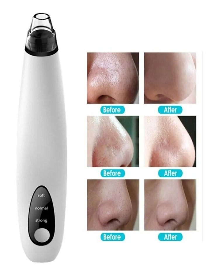 🌀 Electric Blackhead Remover — Diamond Pore Vacuum Suction & Deep Cleanser